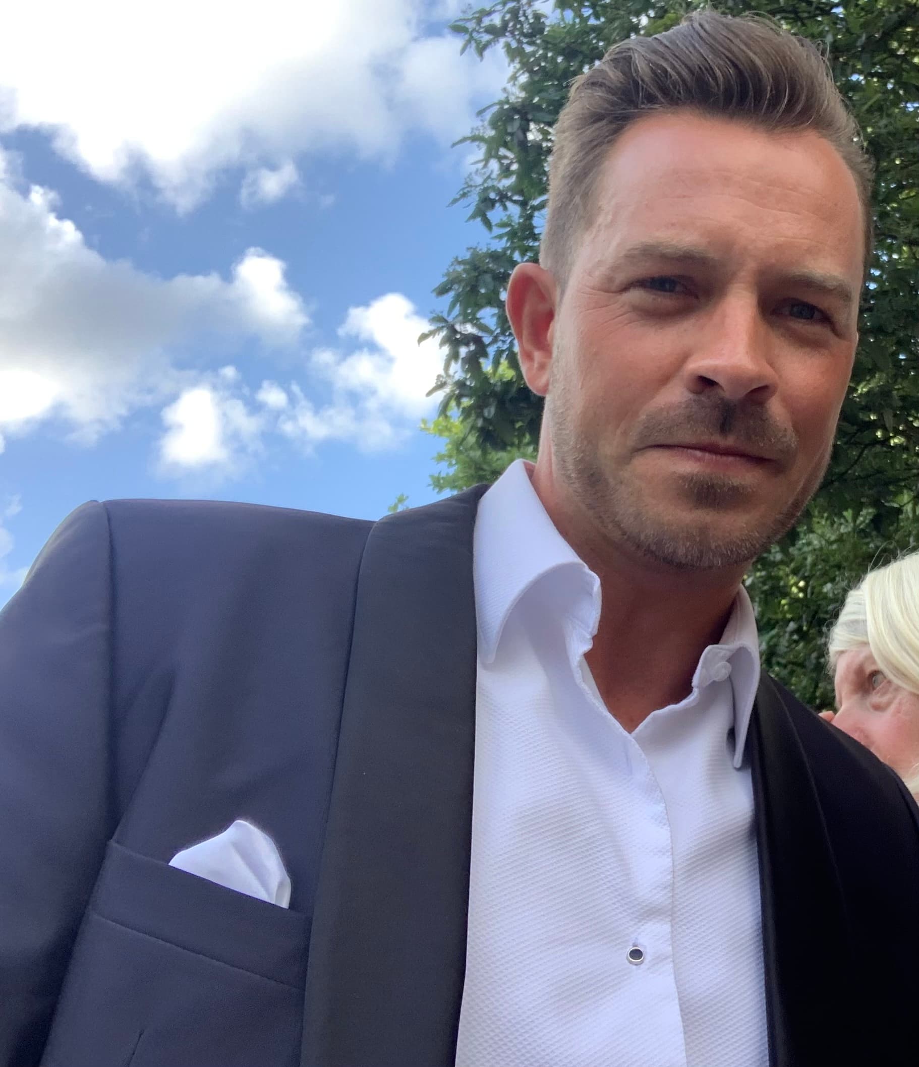 Ashley Taylor Dawson - Actor hair transplant