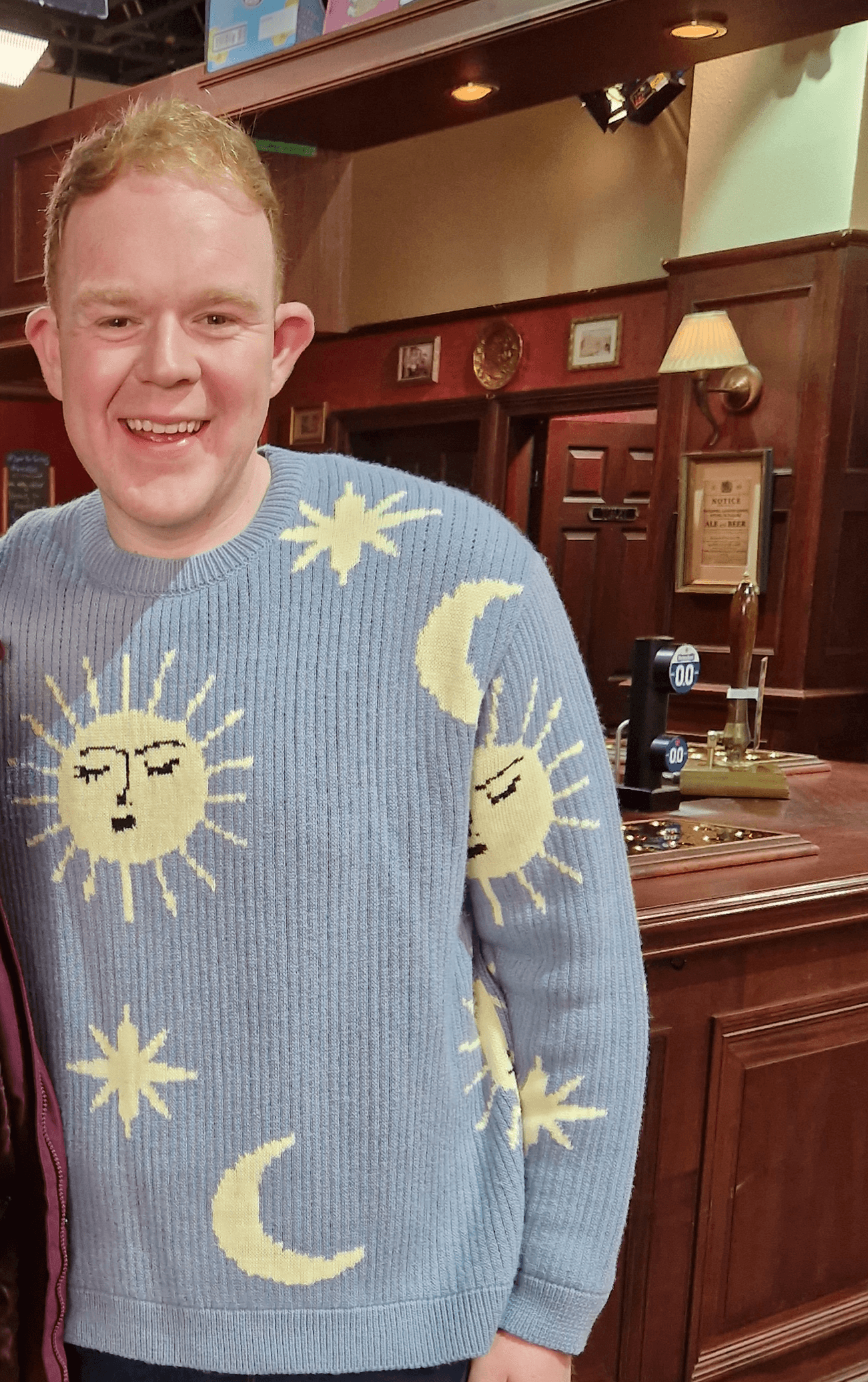 Colson Smith - Actor hair transplant