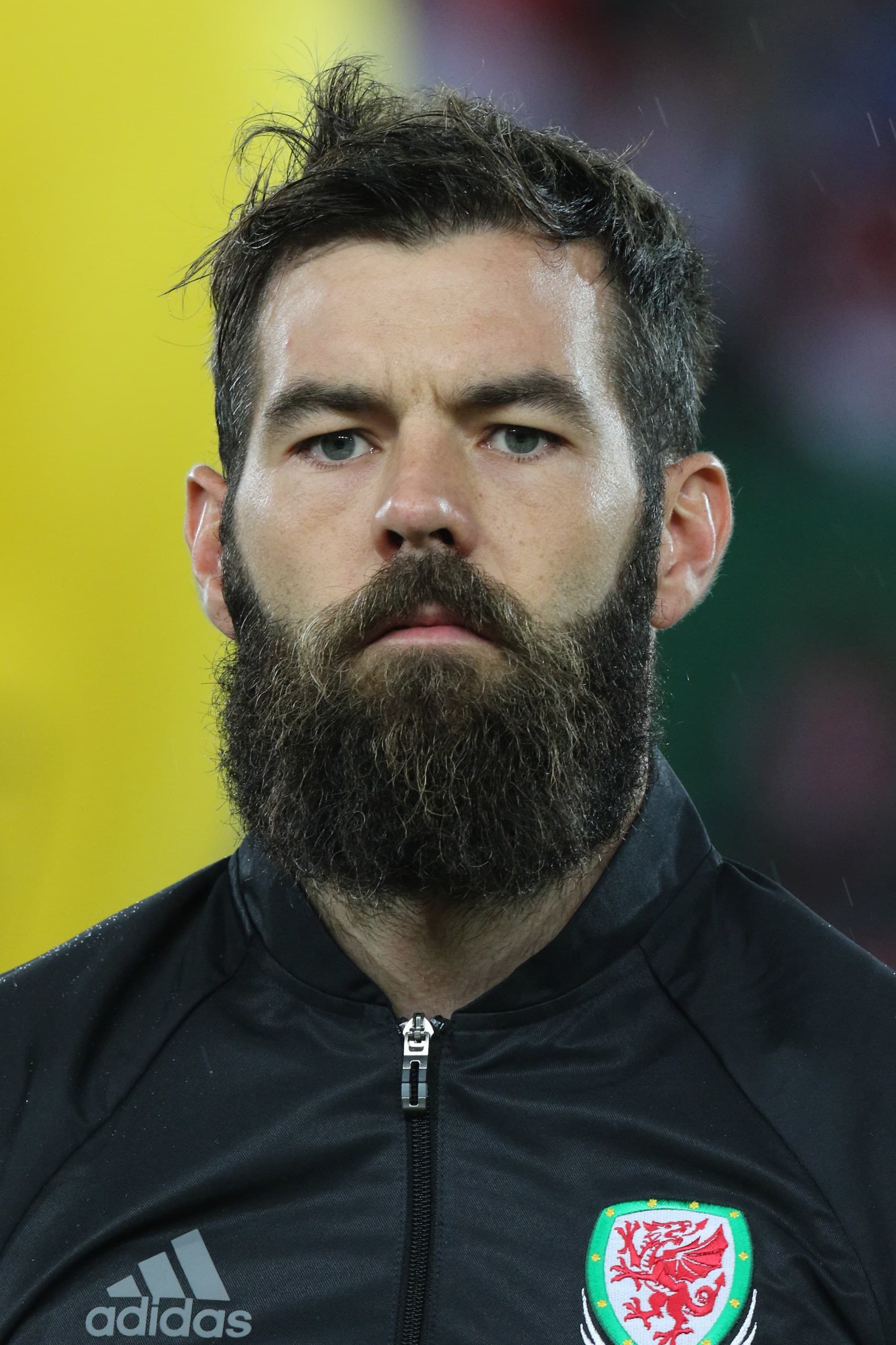 Joe Ledley - Athlete hair transplant