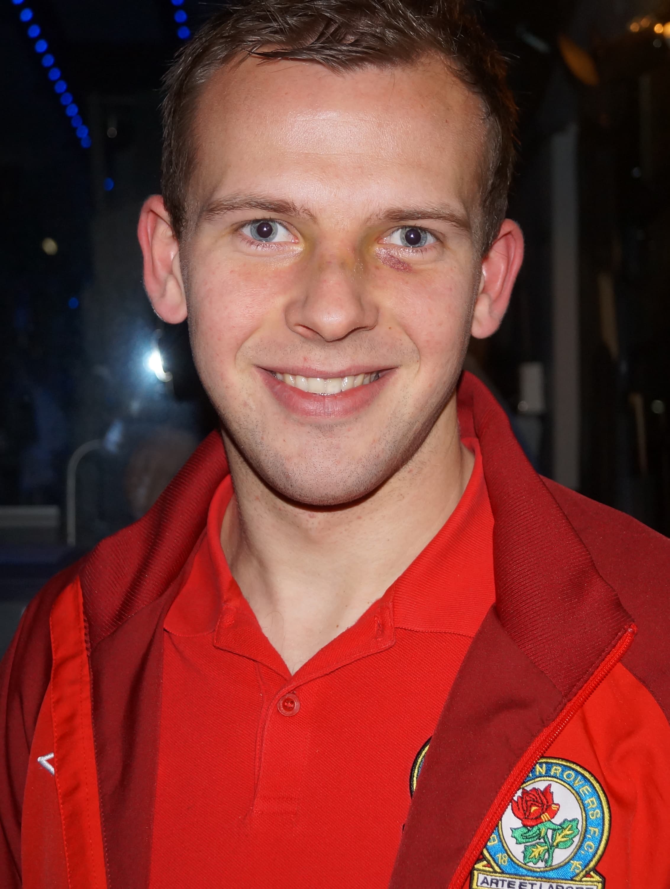 Jordan Rhodes - Athlete hair transplant