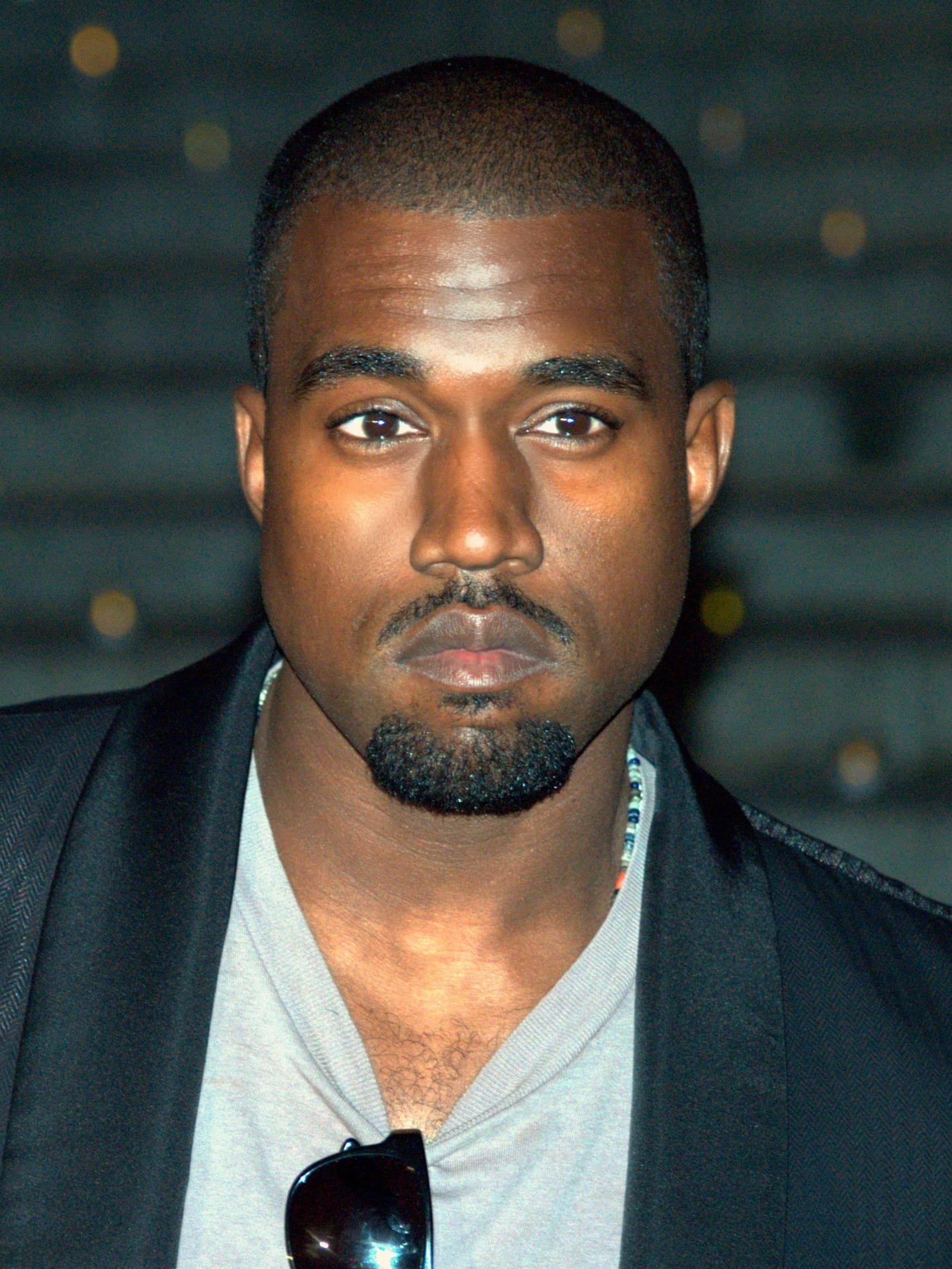 Kanye West - Musician hair transplant