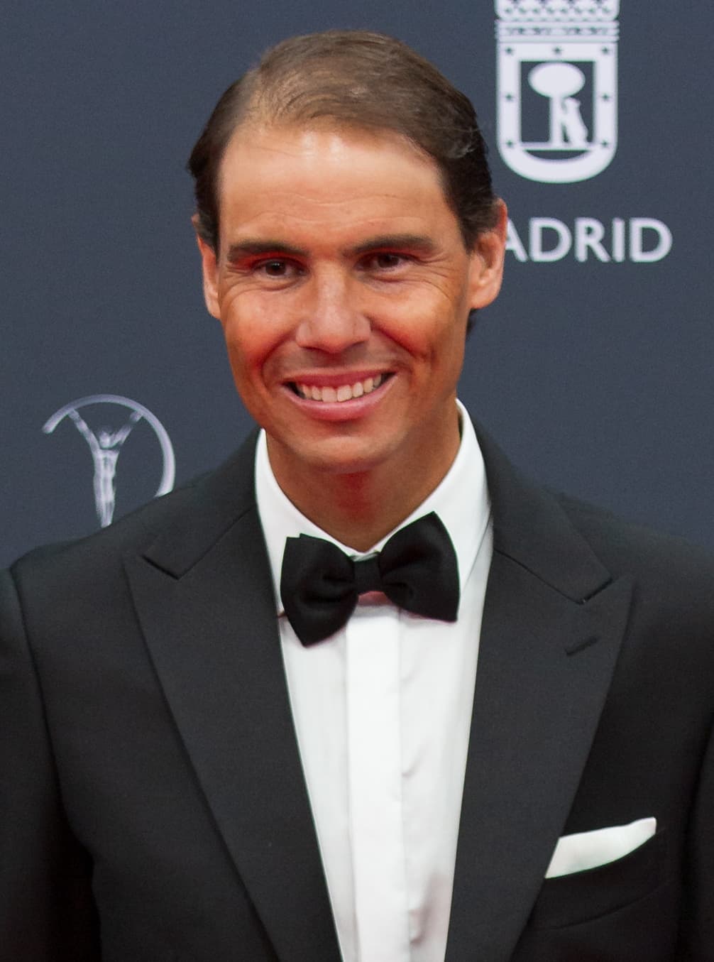 Rafael Nadal - Athlete hair transplant