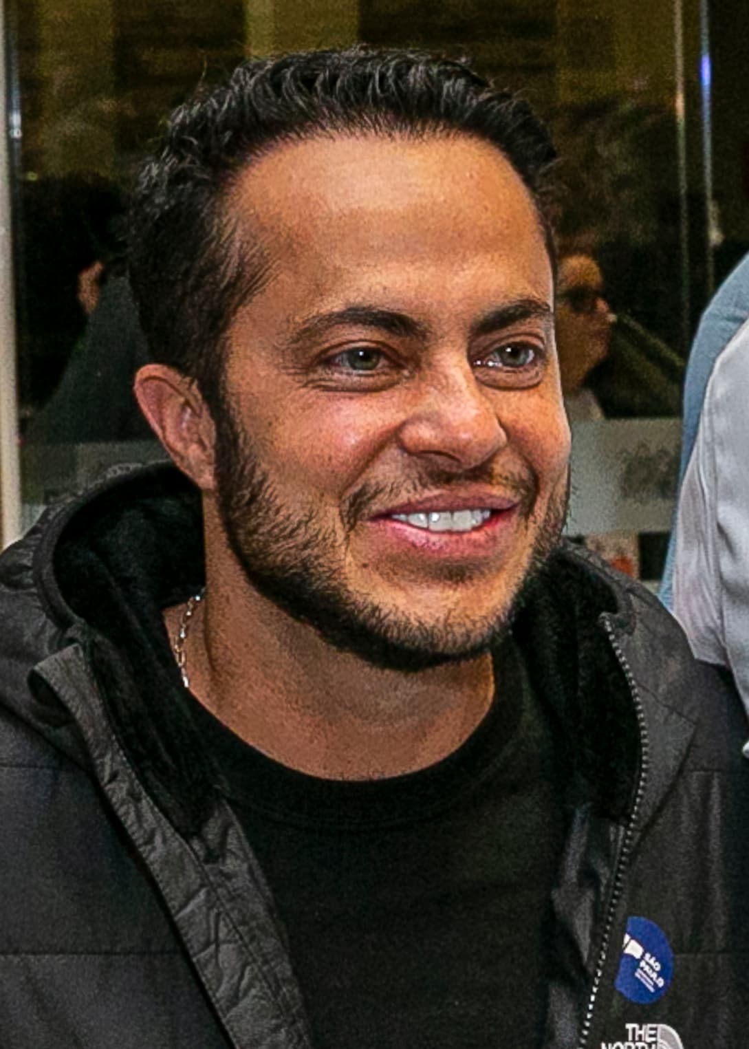 Thammy Miranda - Actor hair transplant