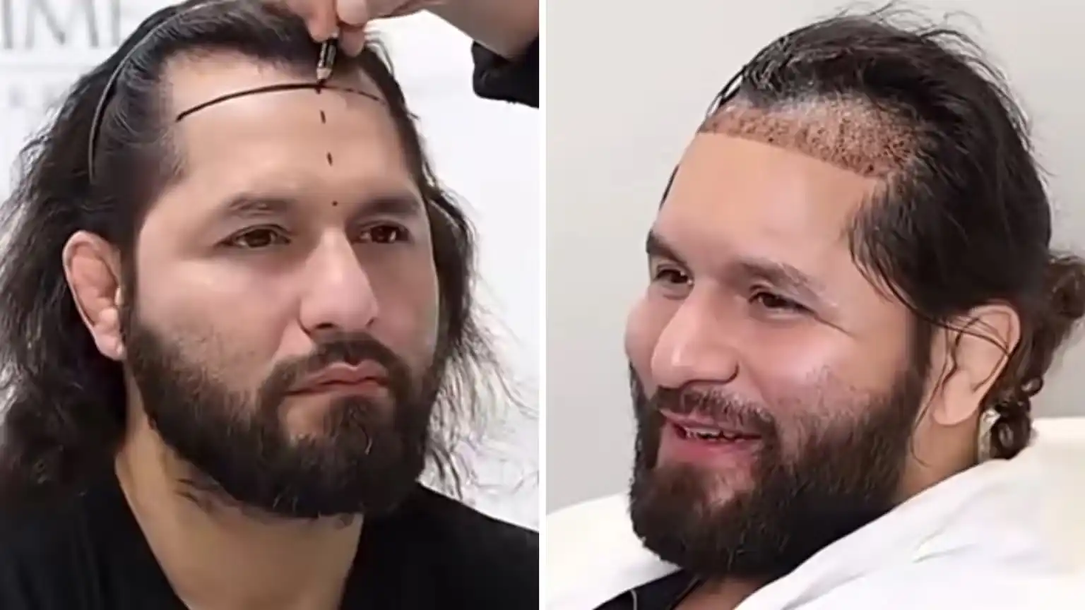 Jorge Masvidal Confirms Hair Transplant at Now Hair Time in Turkey