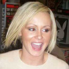 Chanelle Hayes - Musician hair transplant