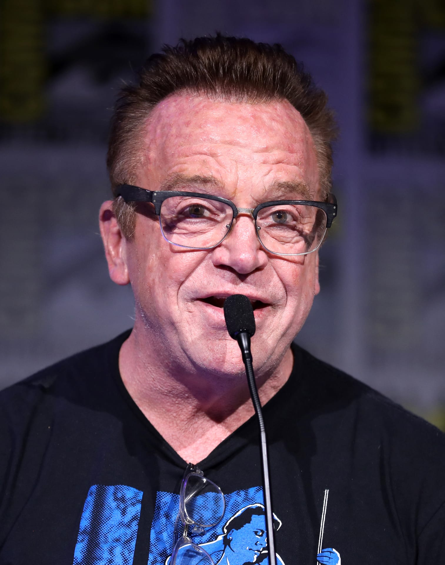 Tom Arnold - Actor hair transplant