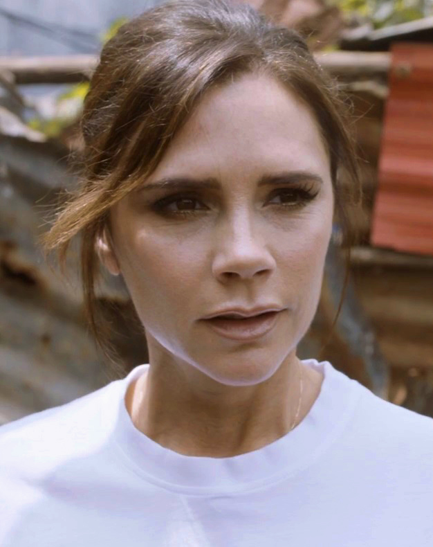 Victoria Beckham - Musician hair transplant